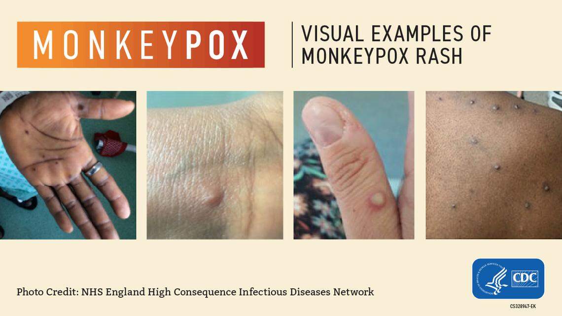 Here’s what to know about monkeypox.