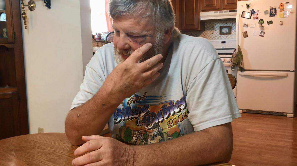 Michael Foppe gestures to his injuries after a July 19, 2018, attack at the Community Interfaith Food Pantry, where he has volunteered for three years. Foppe lost his sight in one eye as a result of the attack.
