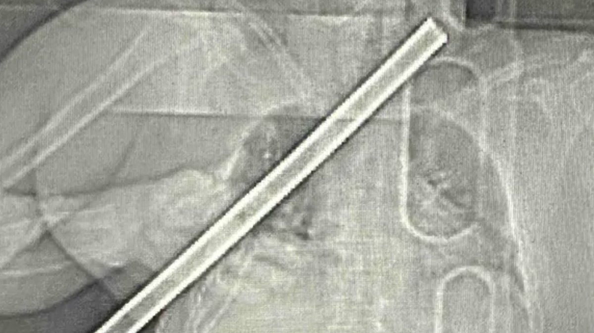 An X-ray image shows where John Davis, of Nashville, Ill., was impaled by a pole in a mid-November accident. He is now home recovering.