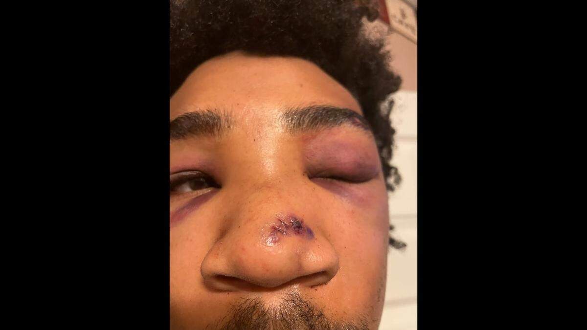 Jaylen Lacey, 22, filed a complaint against the East St. Louis Police Department for an alleged beating against him that happened on March 14