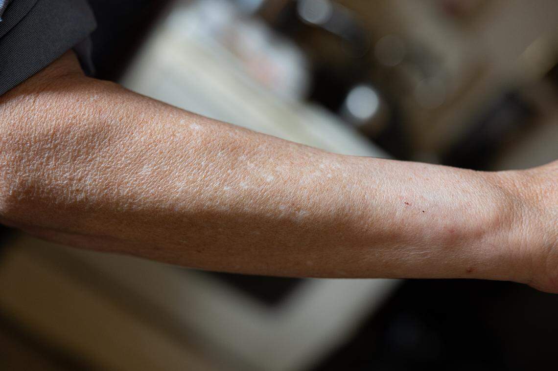 Cahokia Heights resident Arianna Norris-Landry believes the community’s tap water caused rashes that left scarring on her skin.