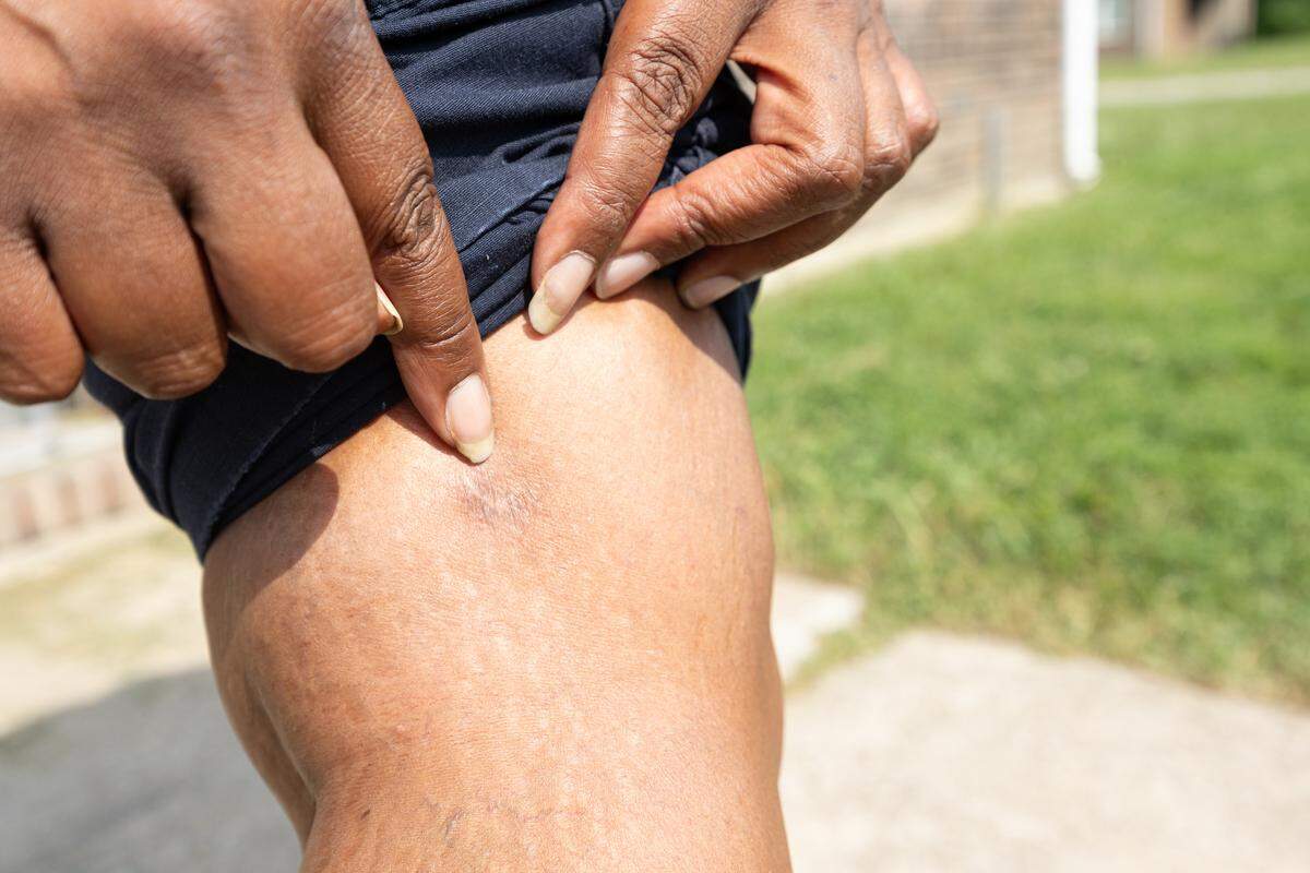 Greystone Apartments tenant Twanna White points to a wound on her leg from when she was shot in 2022 while she was driving in the apartment complex’s parking lot.
