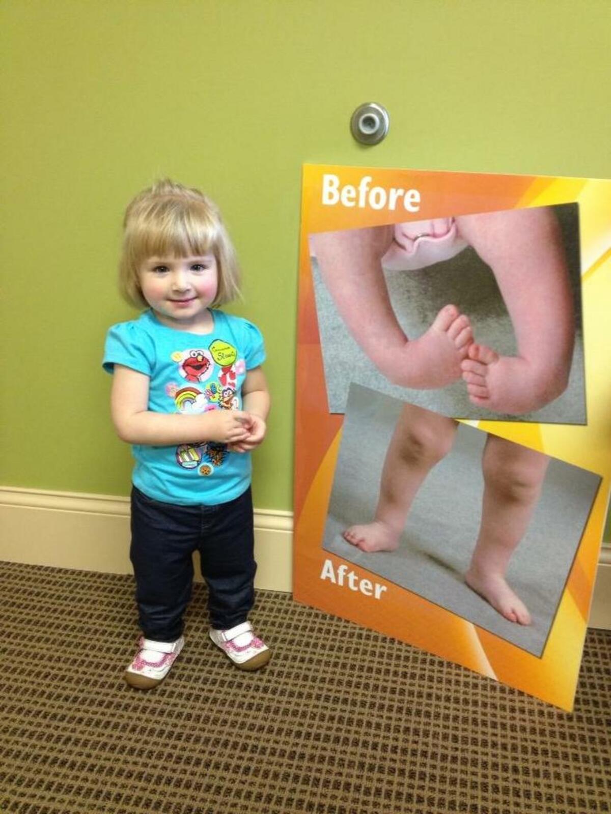 Emma Frick was about 2 years old when she posed beside this poster showing her club feet before and after treatment at Shriners Hospital for Children in St. Louis.