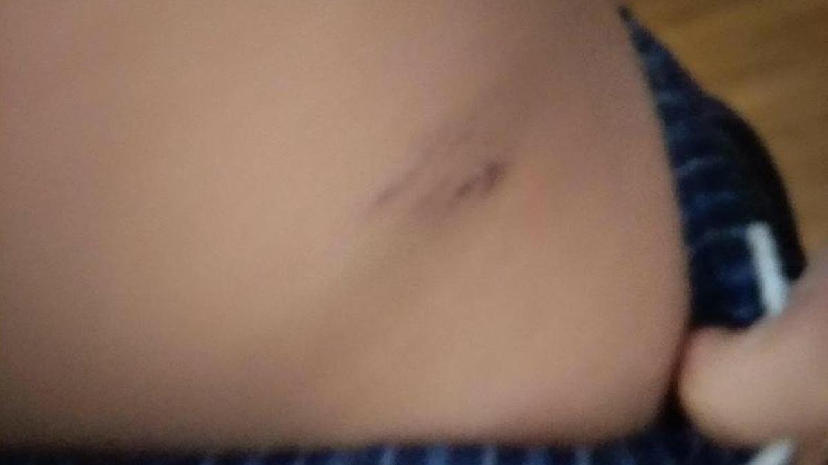 A photo taken on Aug. 28 of Christopher’s injury which he said occurred on Aug. 25.