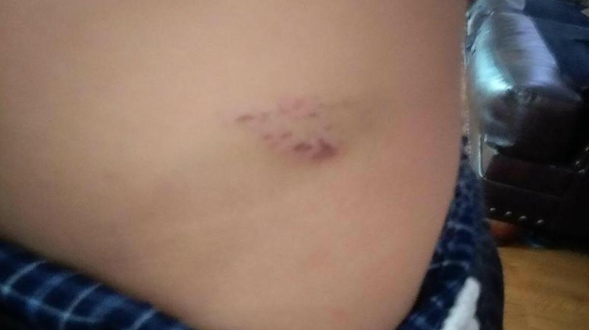 A photo provided by Christopher’s mother, which she said depicts his injury on Aug. 28.