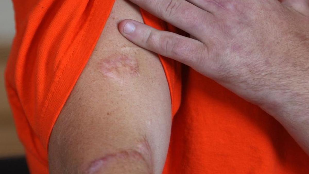 Brian Muller in 2010 showed scars from his heroin use as he discussed trying to fight his addiction. Muller died of a suspected heroin overdose a short time later. The problem has grown since then, in part because heroin is more available and in forms that to not require injection.
